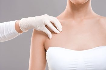 Mão com luva cirúrgica examinando pinta no torso de uma mulher, como um exame da clínica Teresa Noviello